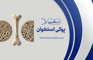 پوکی استخوان (Osteoporosis) یک بیماری شایع است که باعث کاهش تراکم و کیفیت استخوان‌ها می‌شود و آن‌ها را شکننده و مستعد شکستگی می‌کند.